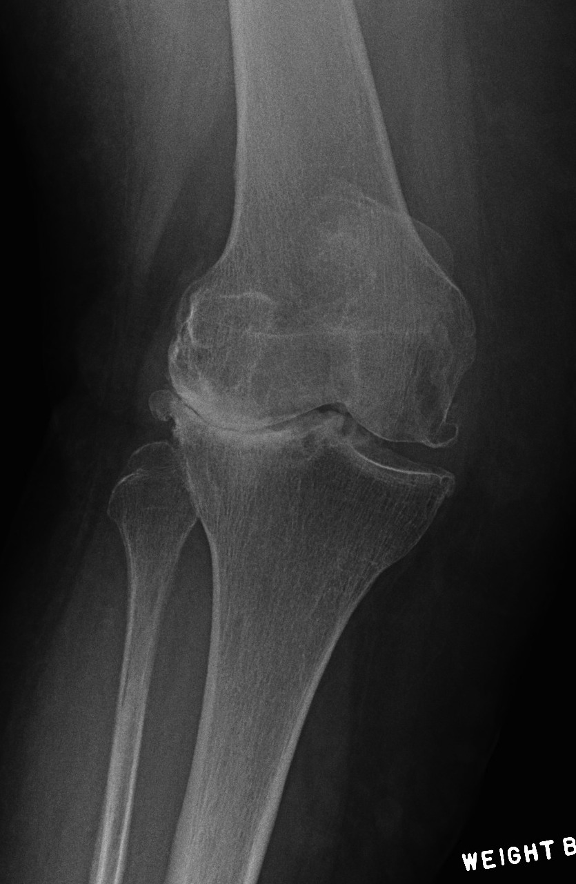 TKR Valgus OA Lateral Bone Loss